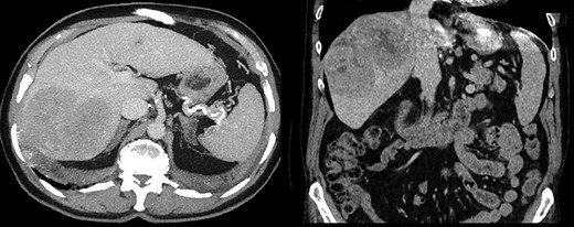 Preoperative CT scan revealing suspected malignancy