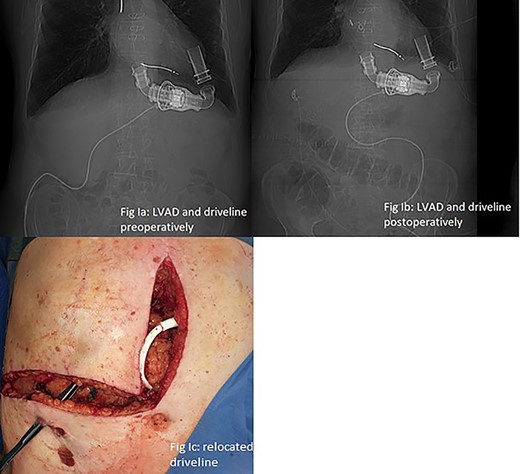 (a and b) LVAD and driveline in preoperative and postoperative CT scan scout. (c) Relocated driveline during laparotomy, forceps in former driveline exit.