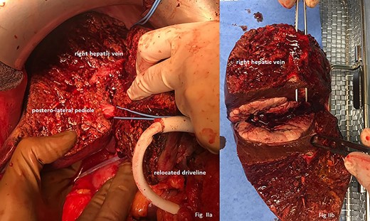 (a) Liver after parenchymal dissection showing the relocated driveline, the postero-lateral pedicle and the right hepatic vein. (b) Macroscopic view on tumour with forceps in right liver vein.