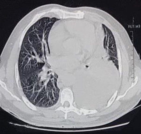 CT scan axial view of anterior mediastinal mass, left lung free pleural effusion and intercostal drainage.
