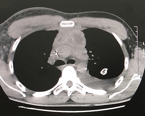 CT scan axial view of a pericardial and left lung pleural effusion.