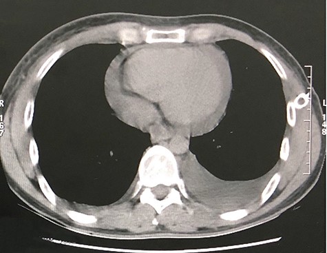 Chest radiography AP view of left pleural effusion.