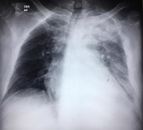 CT scan axial view of left pleural effusion, cardiomegaly and pericardial effusion.