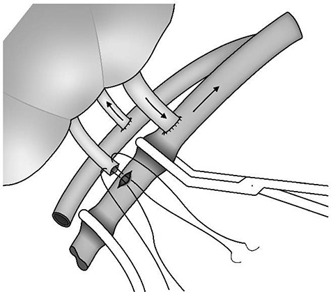 Sequential anastomosis of a lower polar renal vein while the kidney is being perfused.