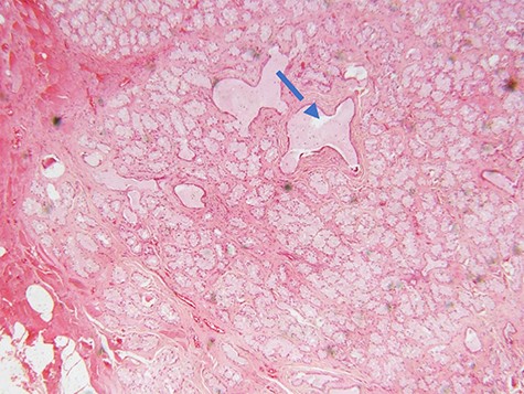 photomicrograph of haematoxylin and eosin (H and E) stained tissue section showing a lobulated mass composed of proliferating acini and some cystically dilated tubules with inspissation of pinkish proteinaceous secretions (arrow) (×40 magnification)
