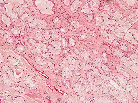 photomicrograph of haematoxylin and eosin (H and E) stained tissue section showing a lesion divided into lobules by fibrous septae in which proliferating and congested blood vessels are seen. The typical columnar to cuboidal mucin-producing epithelial cells are basally located with abundant pale cytoplasm (arrow) (×100 magnification)