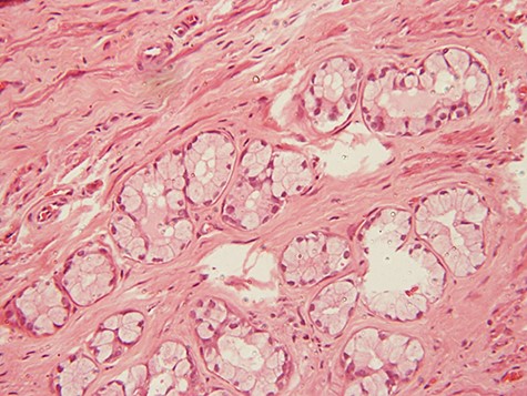 photomicrograph of haematoxylin and eosin (H and E) stained tissue section showing a lesion divided into lobules by fibrous septae. The typical columnar to cuboidal mucin-producing epithelial cells are basally located with abundant pale cytoplasm (arrow) (×200 magnification)