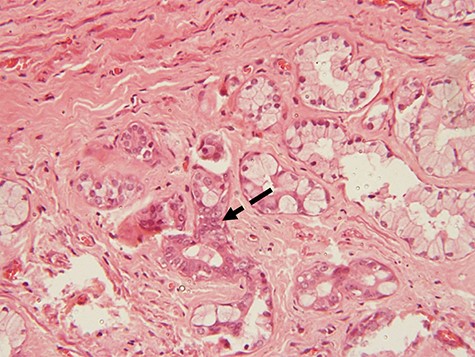 photomicrograph of haematoxylin and eosin (H and E) stained tissue section showing a focus of dysplastic changes. The areas with dysplastic changes show proliferating hyperchromatic and moderately pleomorphic cells causing obliteration of the lumen of the tubules (dotted arrow) (×200 magnification)