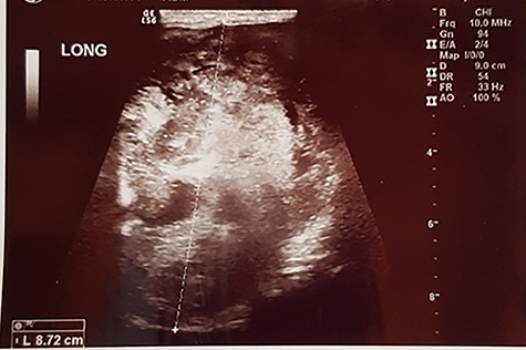 Ultrasound of scrotum