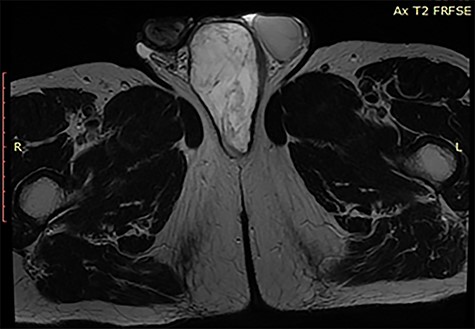 MRI of the scrotum T2