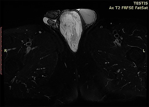 MRI of the scrotum T2 FatSat
