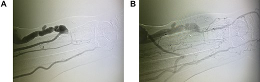 Digital subtraction angiography (DSA) through brachial artery (A) early image showing filling of the ulnar artery and all blood in radial artery is going to the RC AVF (B) late image showing the filling of the radial artery distal to the AVF anastomosis from the ulnar artery by retrograde flow through the palmar arch.