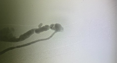 Selective radial artery DSA with shunting of all the blood in radial artery to RC AVF with complete absence of antegrade flow in radial artery beyond the anastomosis.