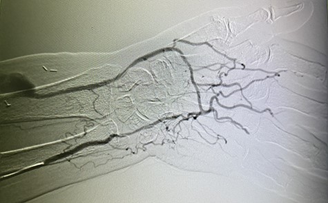Selective ulnar artery DSA showing well-developed palmar arch with retrograde flow in the distal radial artery to supply the RC AVF.