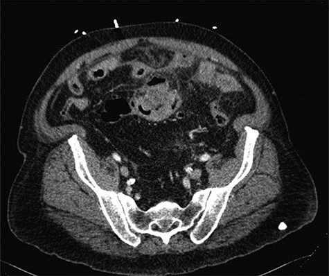 Axial CT imaging of the abdomen, which demonstrates focal thickening of the sigmoid colon with surrounding free fluid.