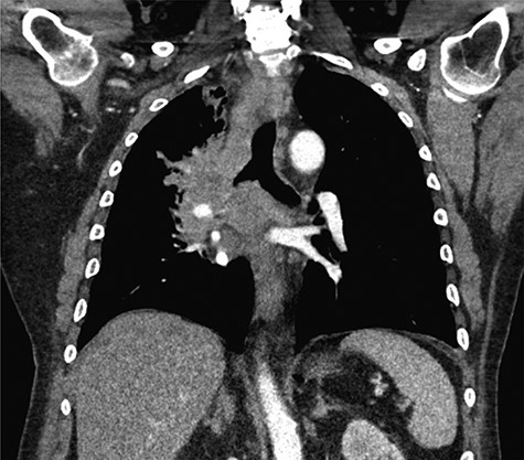 Coronal CT imaging of the thorax demonstrating a large, heterogeneous right perihilar mass with invasion of multiple segmental branches of the right pulmonary artery.