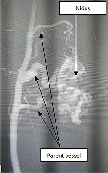 A type IV AVM was seen on angiogram.