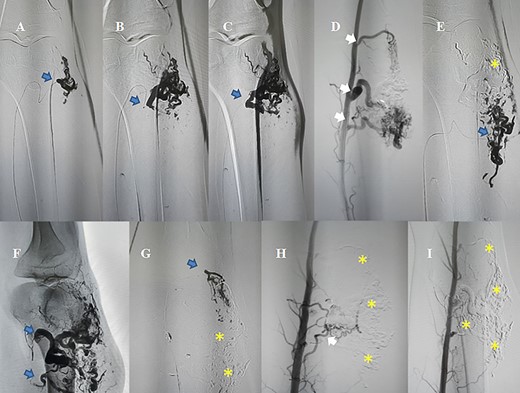 AVM embolization was performed through antegradely femoral approach; white arrows: the existence of feeding arteries need to be occluded; blue arrows: nidus and feeding arteries are being occluded by NBCA/Lipiodol; (asterisk) nidus and feeding arteries were totally occluded.