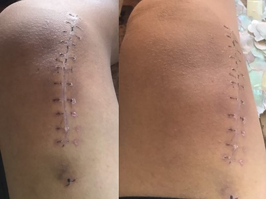 Scar after surgical excision.