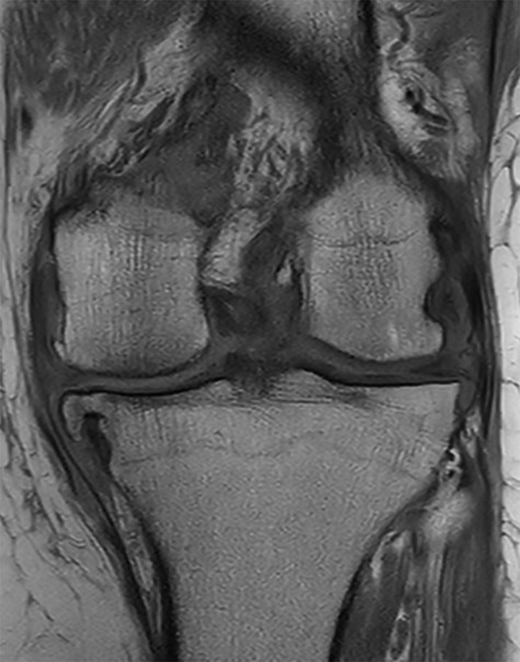 Peroperative MRI.