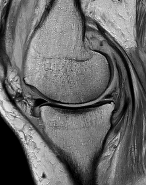 Preoperative MRI.