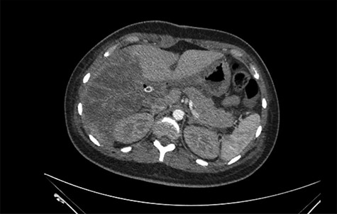 Right liver lobe necrosis and absence of proper hepatic artery on the arterial phase of the triphasic contrast-enhanced abdominal CT.