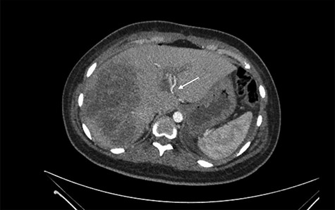 Accessory left hepatic artery (white arrow) on the arterial phase of the triphasic contrast-enhanced abdominal CT.