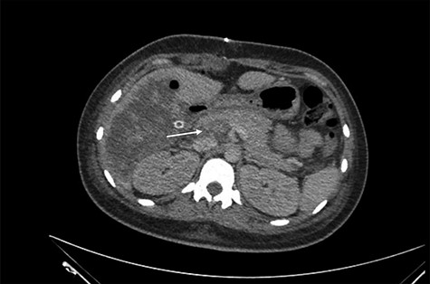 Main portal vein thrombosis (white arrow) on portal phase of the triphasic contrast-enhanced abdominal CT.