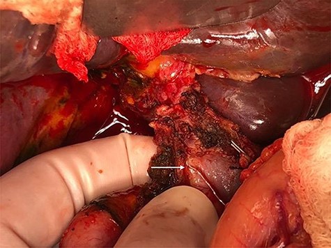 In situ appearance of the hepatic pedicle during exploratory laparotomy. Main portal vein is completely occluded (white arrow).