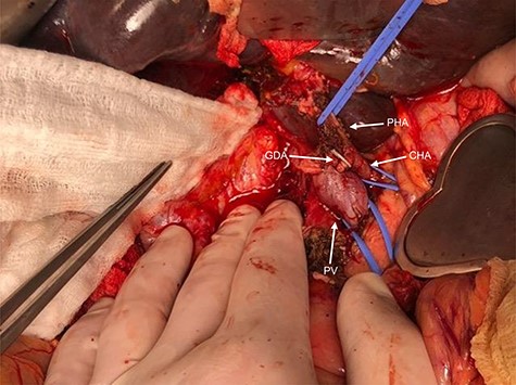 Identification of hepatic pedicle structures. The white arrows show the common hepatic artery (CHA), the completely occluded proper hepatic artery (PHA) and the gastroduodenal artery (GDA) transected for portal vein/superior mesenteric vein (PV) exposure.
