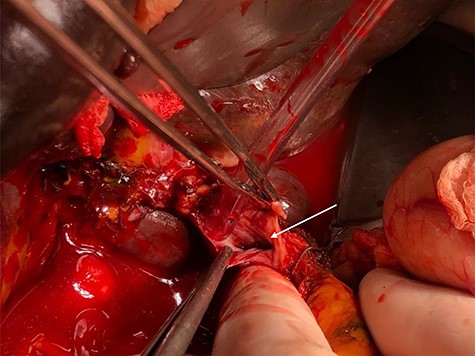 Main portal vein after thrombectomy (white arrow).