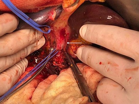 Left portal vein at the level of Rex recessus (white arrow). Also, two S4 portal branches are shown (isolated with vascular loops).