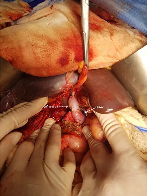 The white arrows show the jump-graft (deceased donor iliac vein) from the superior mesenteric vein (SMV) to the left portal branch at the level of the Rex recessus.