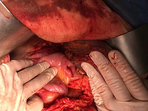 Final image after completion of right hepatectomy and construction of a hepaticojejunostomy to the left bile duct.
