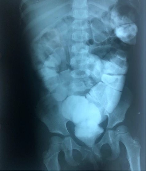 Radiographic abdominal anteroposterior projection of water-soluble contrast enema.