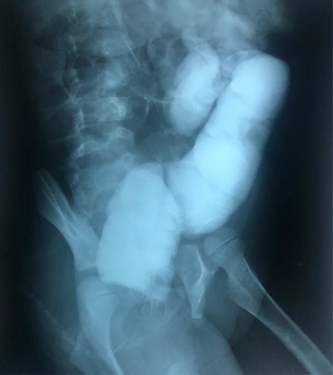 Radiographic abdominal lateral view of water-soluble contrast enema.