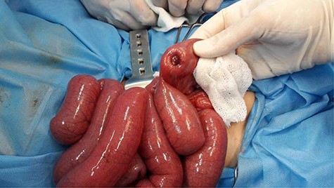 Exploration of the ileum revealed a focally depressed region where a small intraluminal mass was palpated.