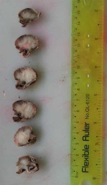 Gross section of the tumor reveals whitish-grey surface with whorled appearance.