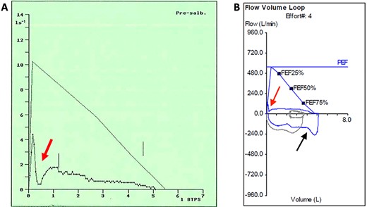 Pre-operative flow-volume loops: (A) expiratory flow-volume trace from initial presentation aged 26 years demonstrates pressure-dependent collapse on expiration (red arrow); (B) complete flow-volume loop obtained aged 48 years demonstrates a similar appearance with clipping of the inspiratory loop (black arrow) due to variable intrathoracic obstruction by the tracheal leiomyoma.
