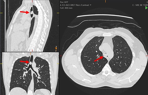 Multiplanar reformation of the chest computerized tomography demonstrating the tracheal mass (red arrows).