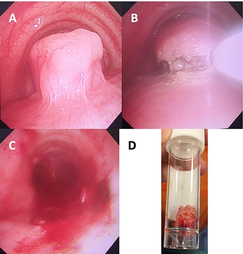 Images of the mass obtained intraoperatively: (A) bronchoscopic view of tracheal leiomyoma; (B) laser resection; (C) post-resection view; (D) resected tumour in a specimen tube.
