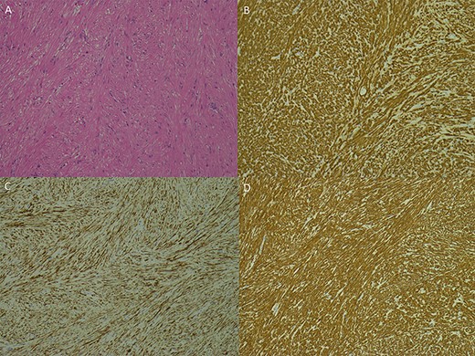 Photomicrographs of the specimen: (A) spindle cell lesion, haematoxylin and eosin; (B–D) immunohistochemistry with H-cadesmon (B); desmin (C), smooth muscle actin (D); all at ×100 magnification.