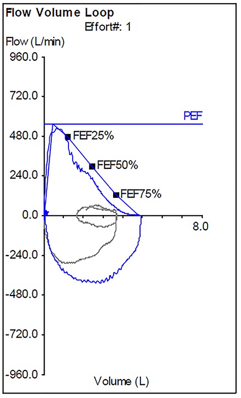 Post-operative flow-volume loop demonstrating a normal appearance.