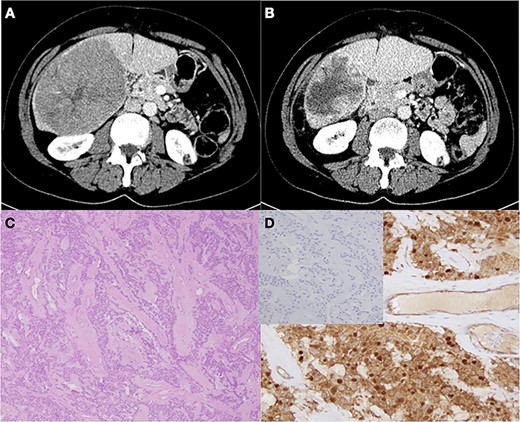 CT imaging of metastatic recurrent SPNP in right hepatic lobe before (A) and after (B) Y-90 treatment. (C) Characteristic pseudopapillae with hyaline stroma (H&E staining, ×4 magnification). (D) Confirmatory β-catenin immunostaining with negative chromogranin A staining (inset)