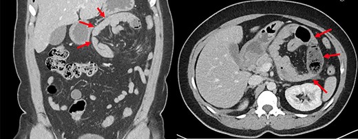 Abdominopelvic CT scan depicting a left paraduodenal hernia containing a jejunal loop with fecalization (arrows).