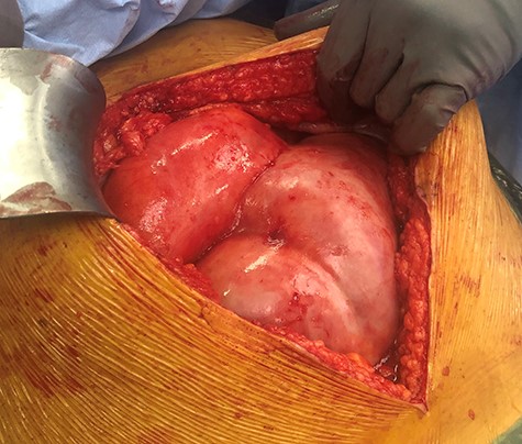 Operative appearance of grossly dilated bowel and thickened peritoneal membrane.