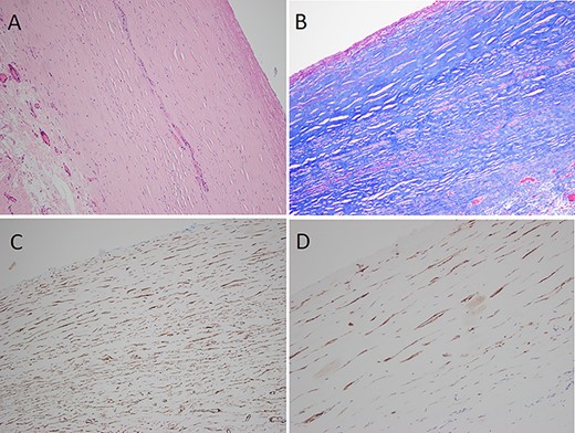 Histopathological examination (A) thick dense collagenous fibrous tissue with denuded mesothelial lining (H&E), (B) Masson trichrome stain confirming collagenous fibrous tissue, (C) smooth muscle actin immunohistochemistry showing myofibroblasts within the fibrous tissue, (D) D2-40 immunohistochemistry showing lymphatic endothelial cells.