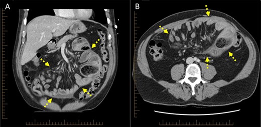 Computed tomography scan (A) coronal cross-section, (B) axial cross-section demonstrating ‘cocoon-like’ membrane enveloping dilated loops of small bowel (arrow).