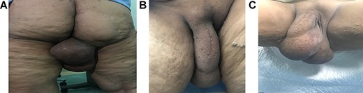 Gross images of the mass in a standing view showing the relations to the vulva and gluteal regions, (A) posterior view showing the scar from a previous surgery in the right gluteal area and the extension of the mass, (B) anterior view in a standing position and (C) lithotomy, respectively.