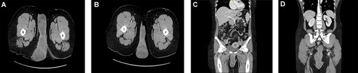 Multiple cuts of a CT abdomen and pelvis scan showing a multicompartmental, multilobulated, low pelvic and perineal soft-tissue lesion, with heterogeneous enhancement, measuring almost 21 × 17 × 5 cm.